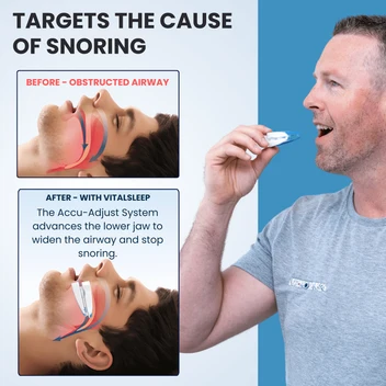 Anatomical diagram: Before obstructed airway vs After with VitalSleep Accu-Adjust System
